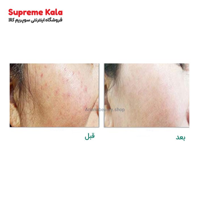 سرم آربوتین لیزر وایت