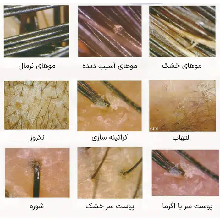 دستگاه اسکالپ مو و سر 5 کاره لیز