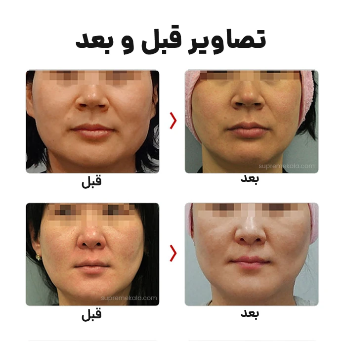 دستگاه هایفو دابلو گلد - Hifu Gold Premium