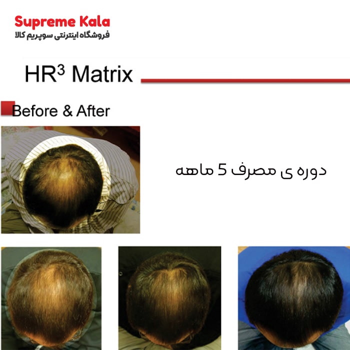 کوکتل HR3 ژنوسیس ضدریزش و رویش مجدد مو ماتریکس