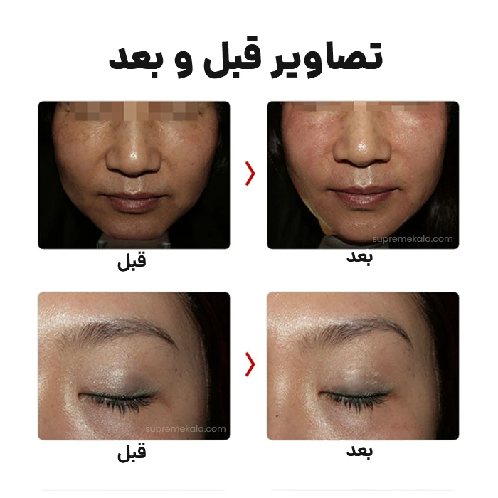 دستگاه هایفو دابلو گلد - Hifu Gold Premium