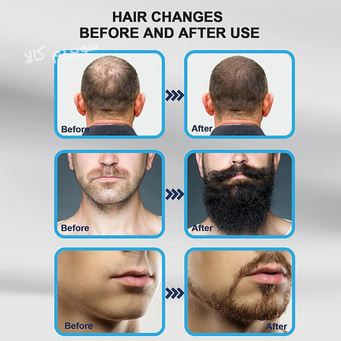 درما استامپ DRS مدل 140 سوزنه
